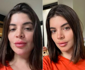Gkay retira preenchimento lábios