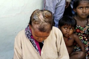 Chifres crescem na cabeça de mulher na Índia: “dor insuportável”
