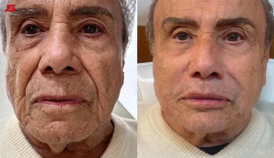 Stênio Garcia surpreende ao realizar harmonização facial aos 91 anos
